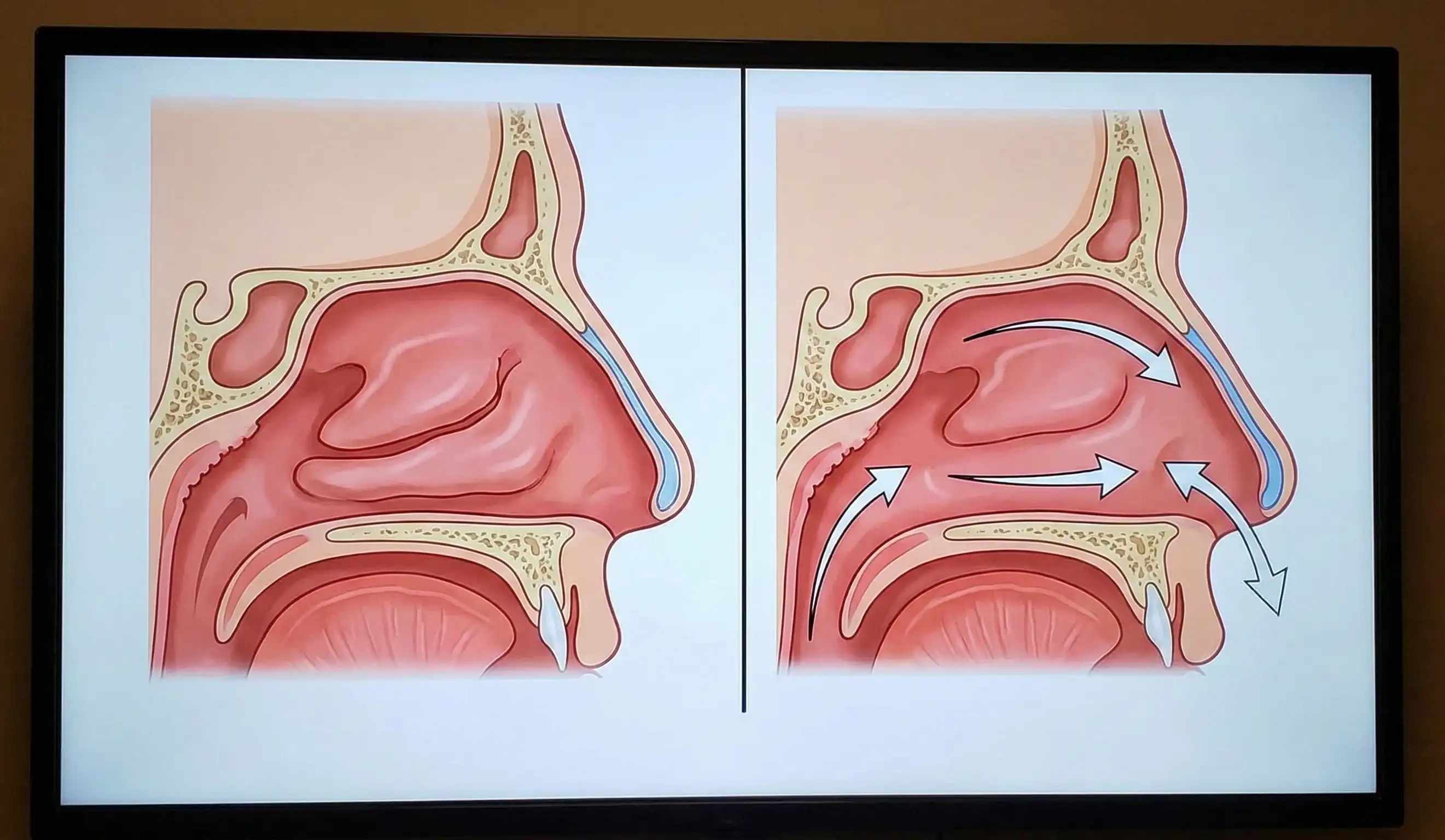 medical diagram nasal airflow before after rhinoplasty