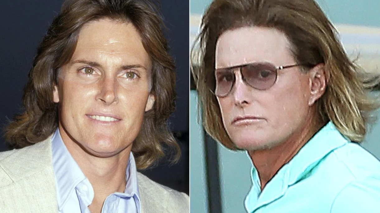 caitlyn jenner до операции