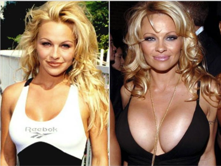 Pamela Anderson: до и после увеличения груди