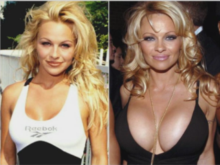 Pamela Anderson's Breast Transformation: Before and After