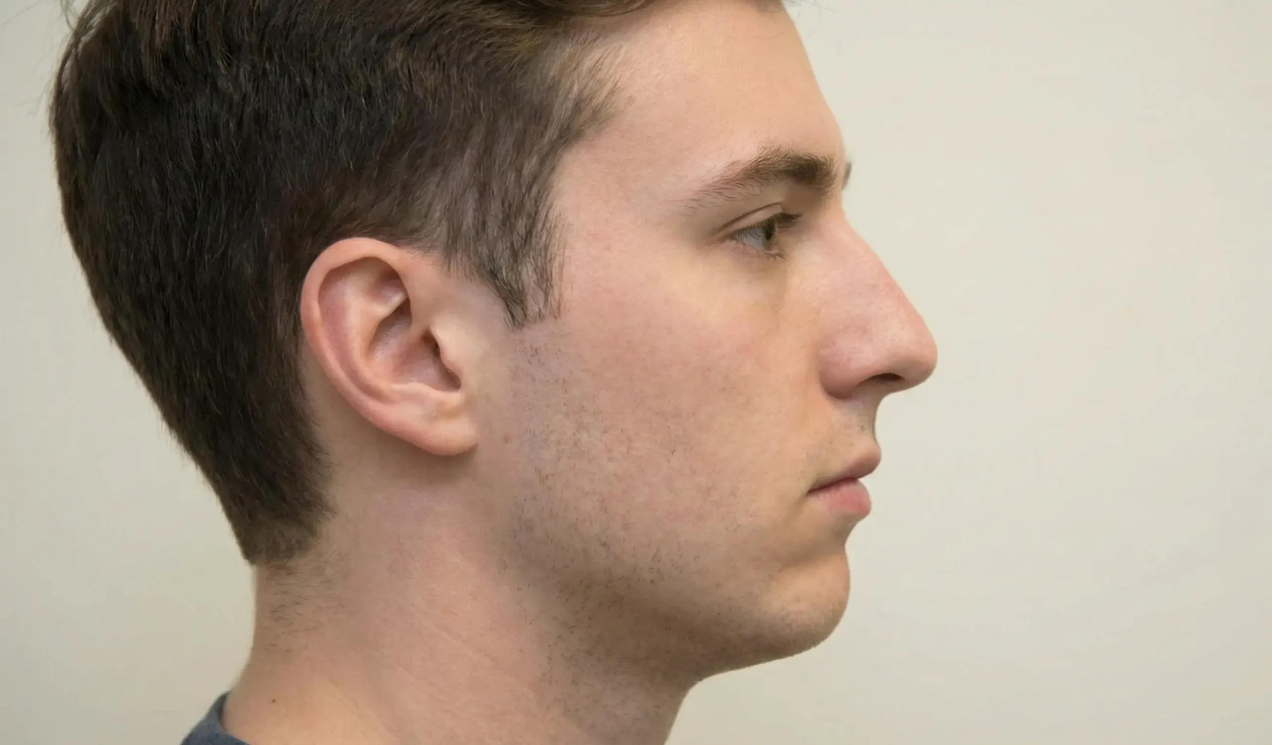 side profile recessed chin male