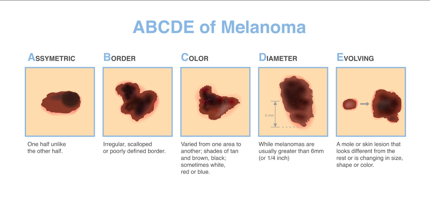 a b c d e of melanoma