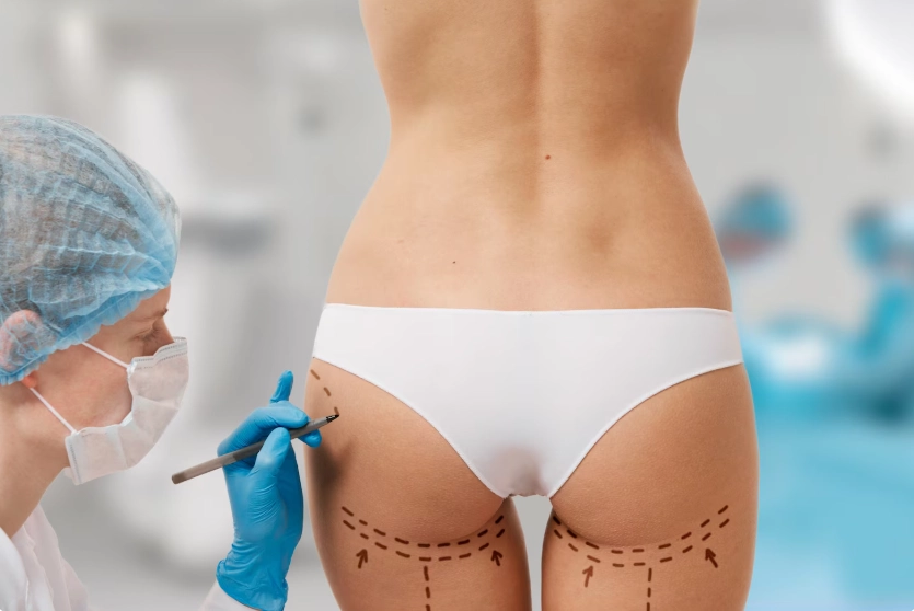 How Does a BBL (Brazilian Butt Lift) Work?