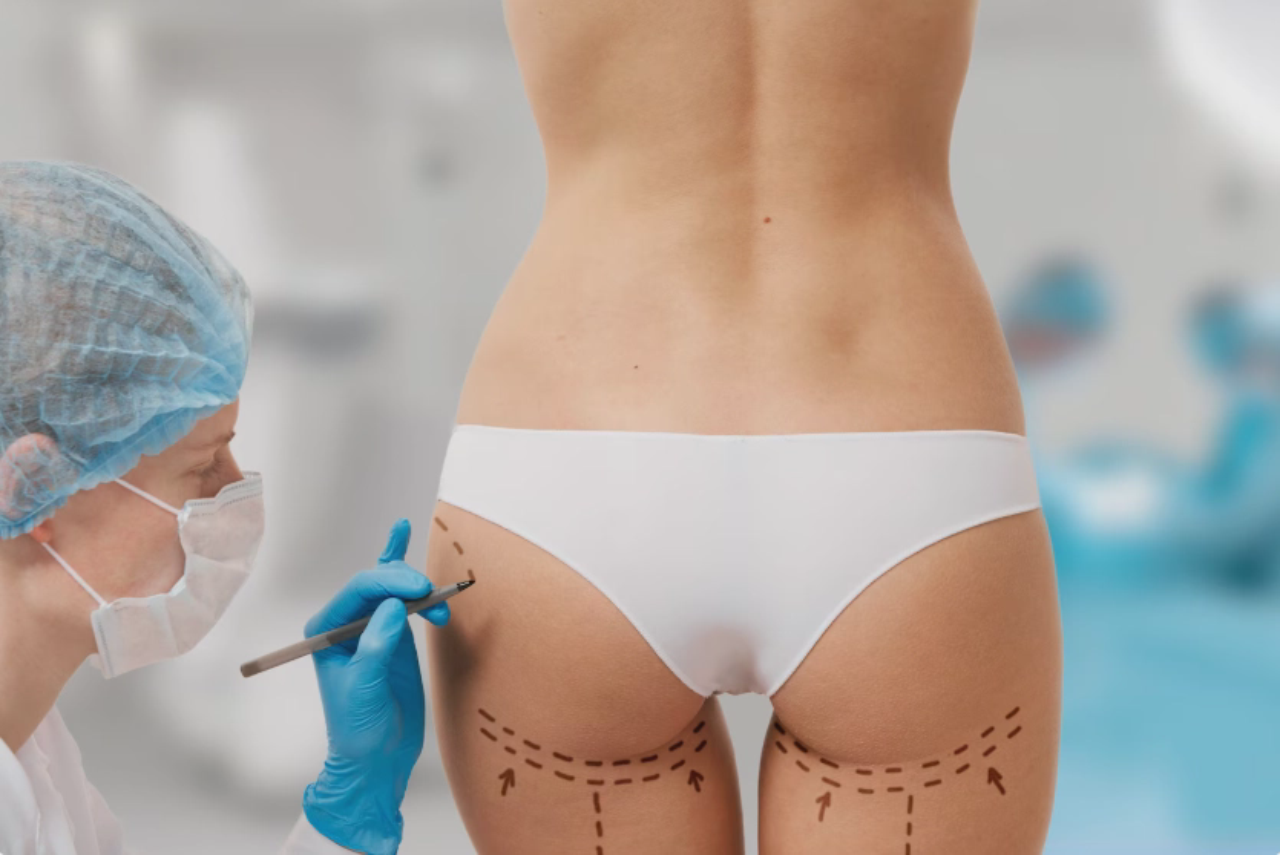 How Does a BBL (Brazilian Butt Lift) Work?