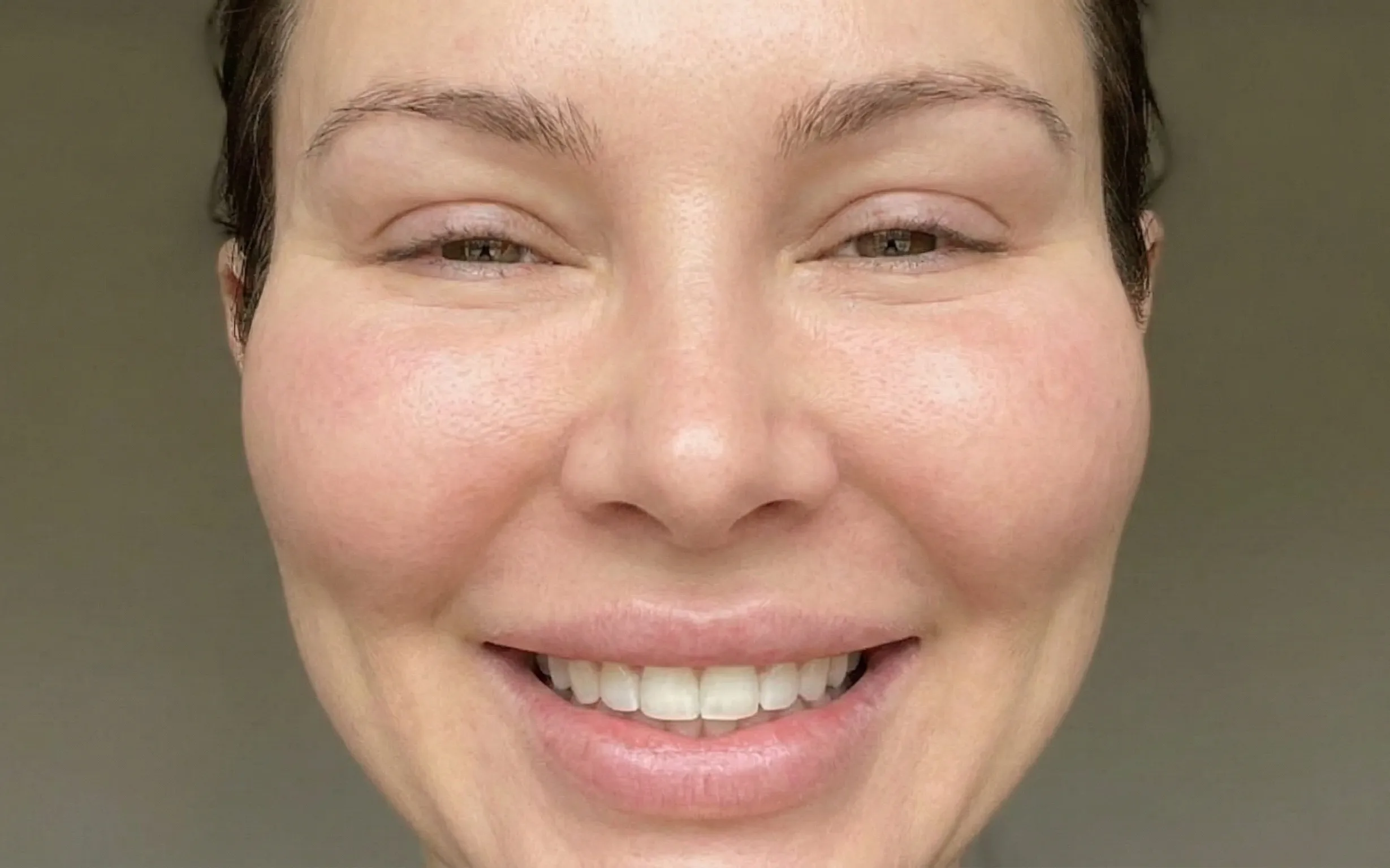 woman smiling excessive cheek filler pillow face effect
