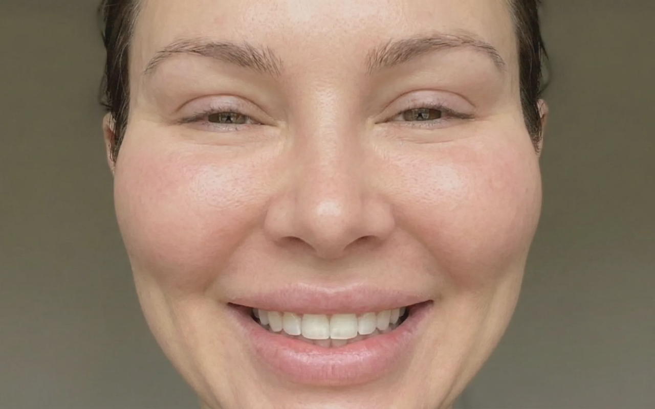 woman smiling excessive cheek filler pillow face effect