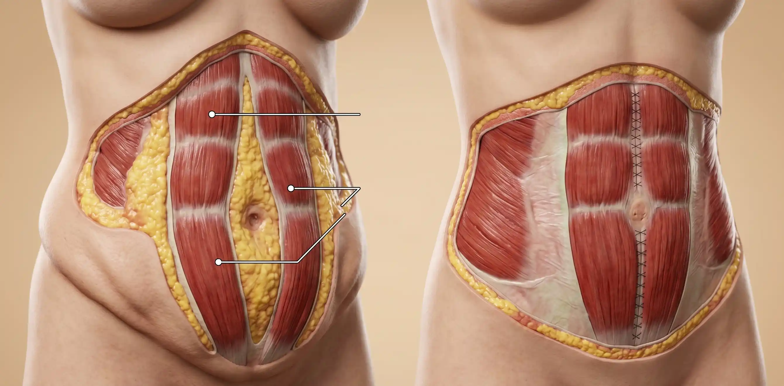 anatomical model abdomen pregnancy tummy tuck