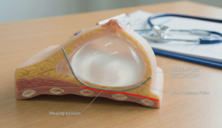 anatomical model underwire incision risk
