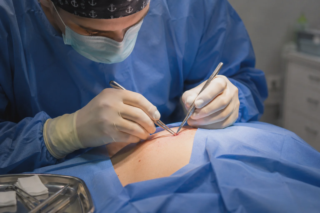 mole removal surgery