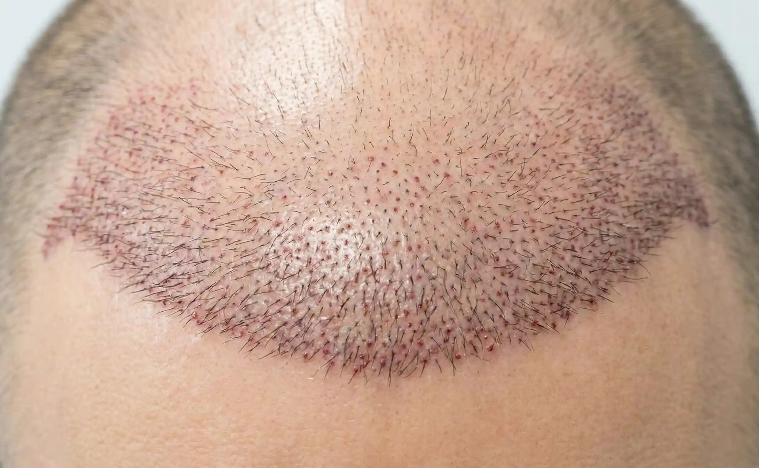 dense hair transplant result after sapphire fue procedure