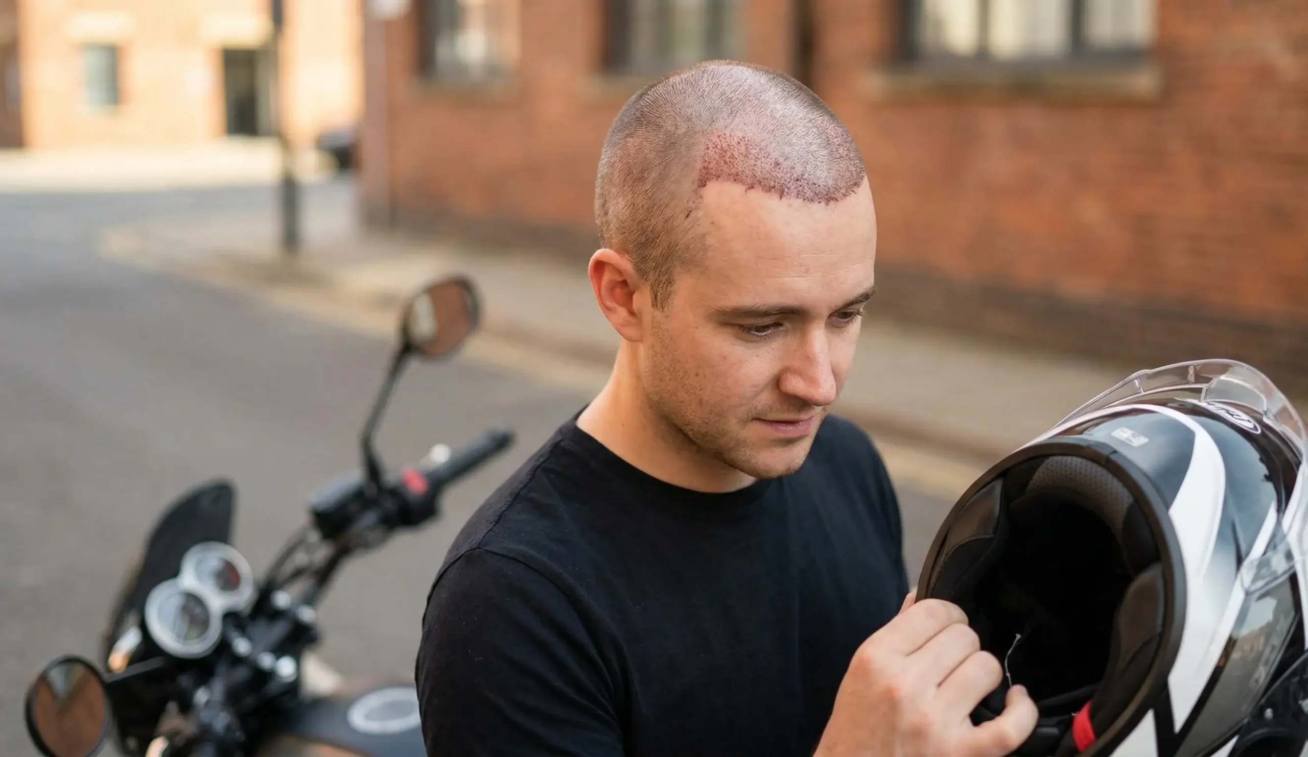 patient motorcycle helmet post hair transplant examination