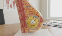 anatomical breast model fat graft living zone vs oil cyst