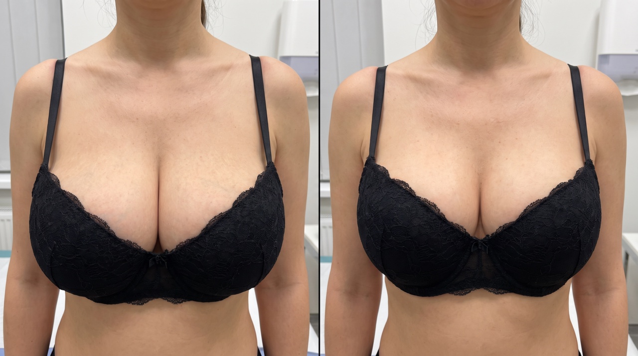 Breast Reduction: How to Decrease Breast Size with Surgery?