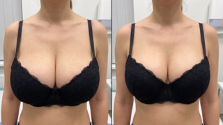 Breast Reduction: How to Decrease Breast Size with Surgery?