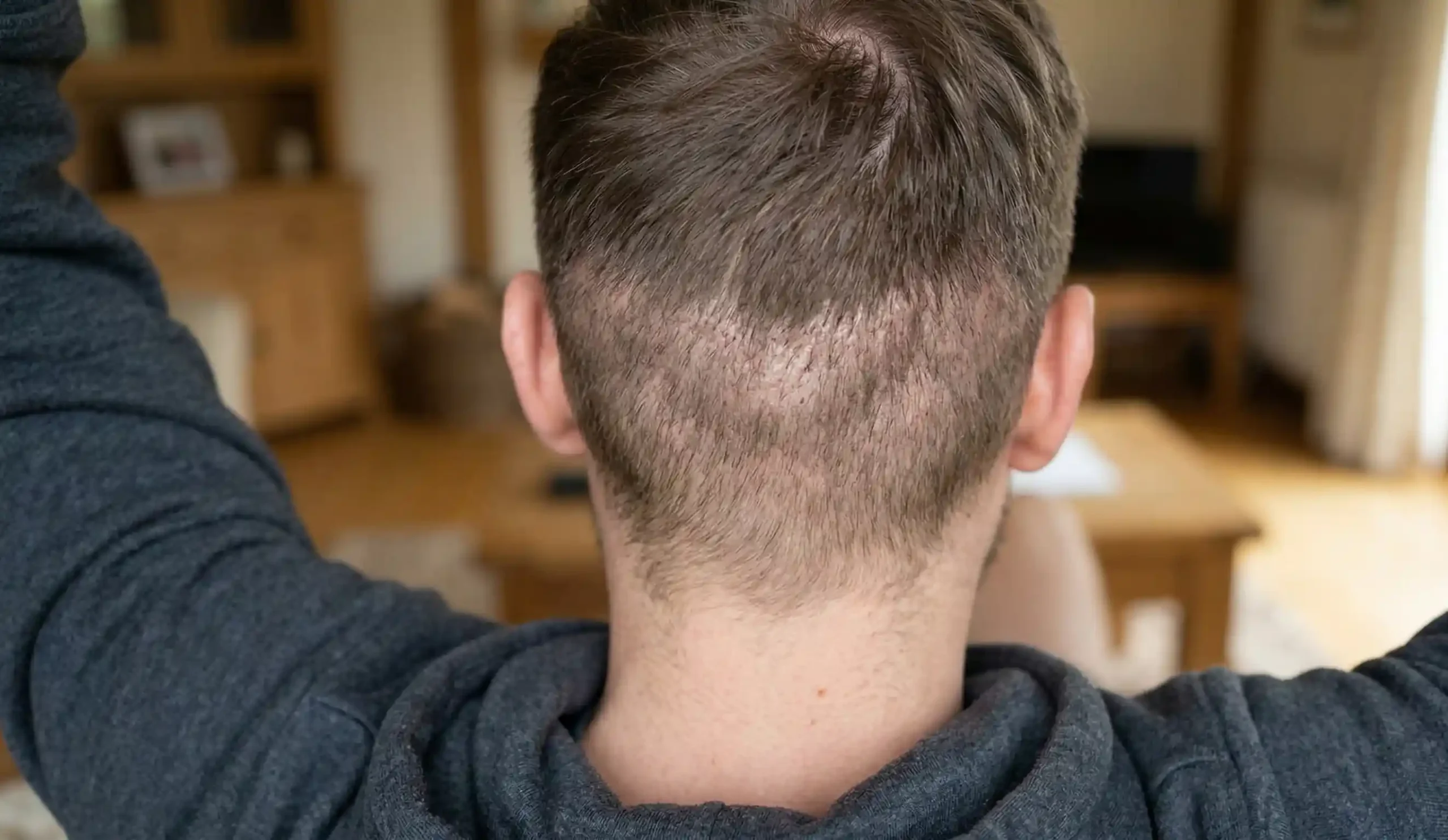 post hair transplant thin donor area