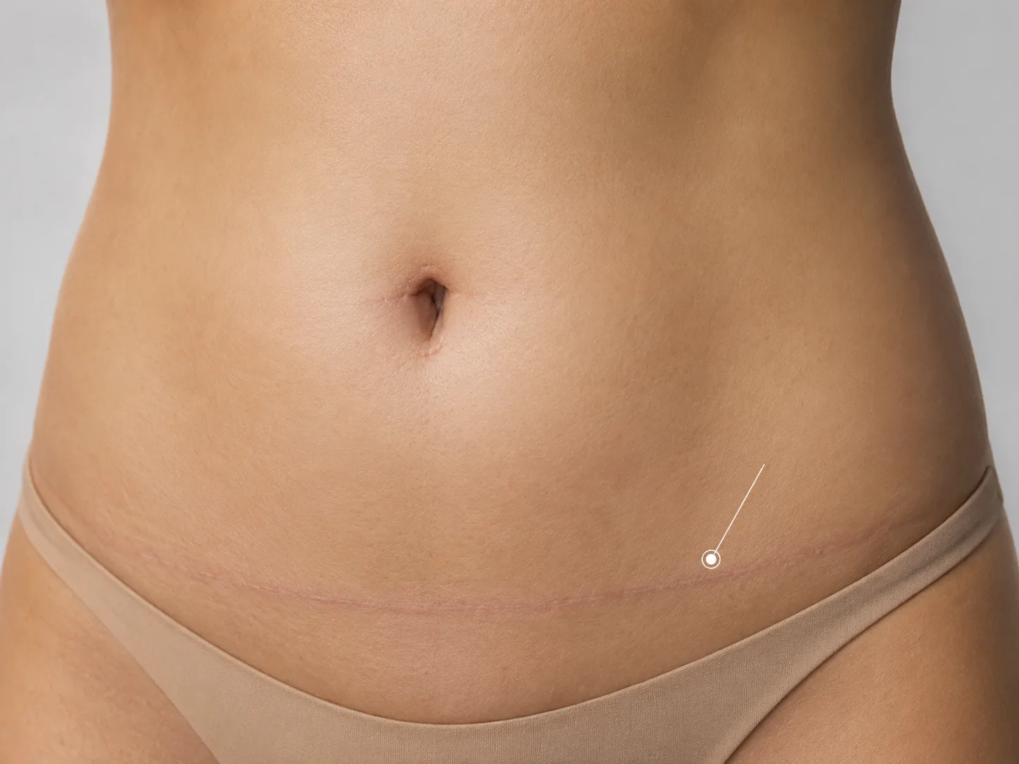 tummy tuck scar
