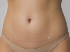 tummy tuck scar