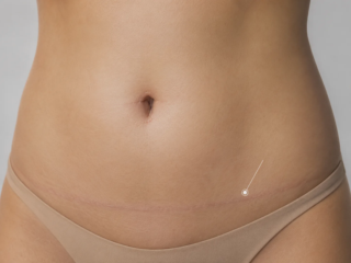 tummy tuck scar
