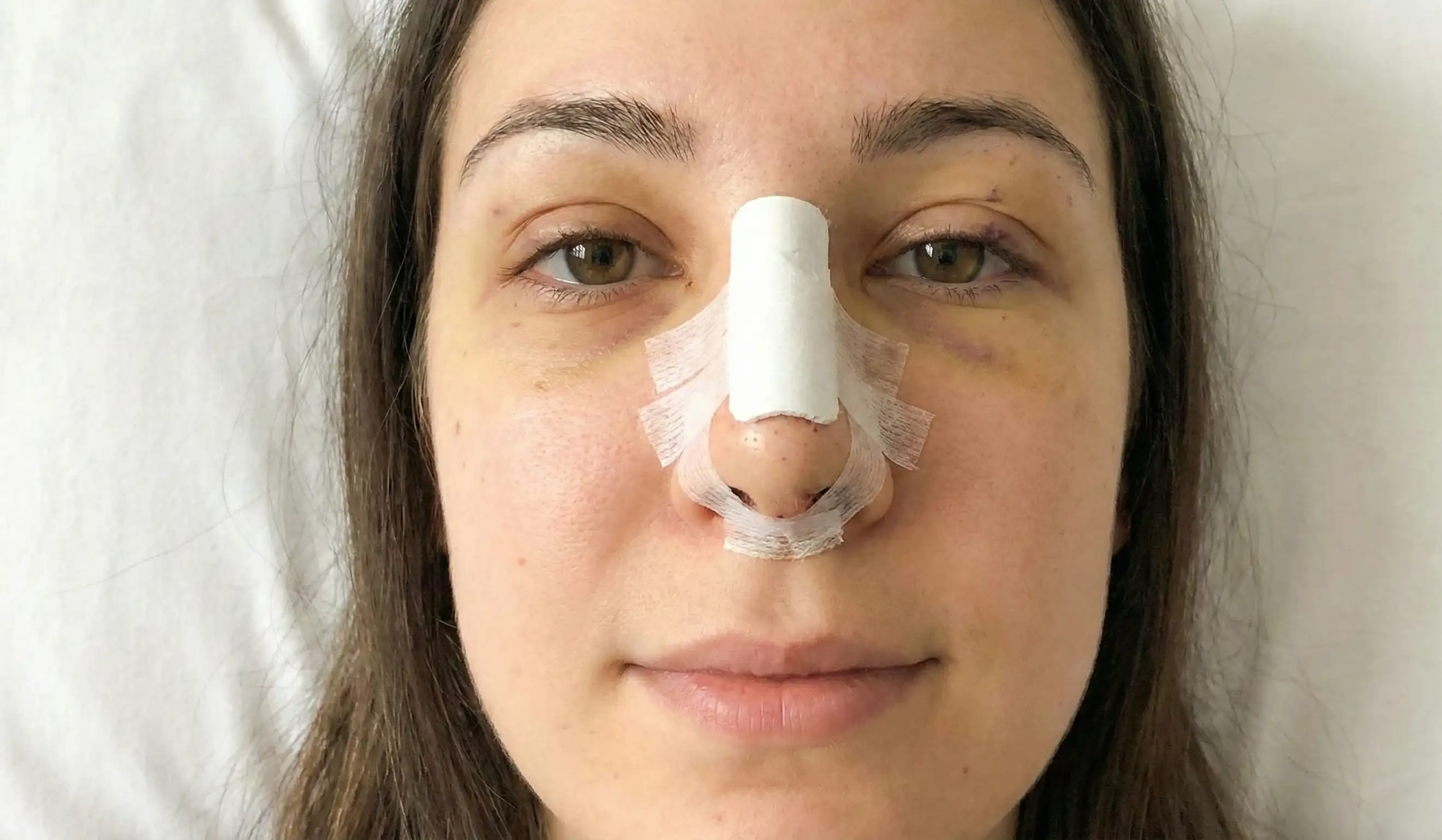 rhinoplasty early recovery patient with splint and tapes natural photo
