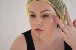 Fat Transplant for Face: How Long Does Fat Transfer to Face Last?