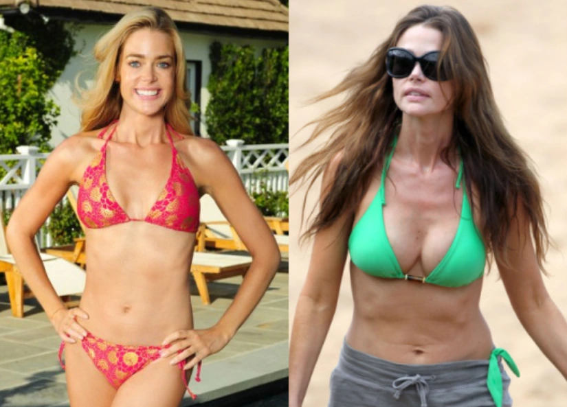 denise richards breast implants