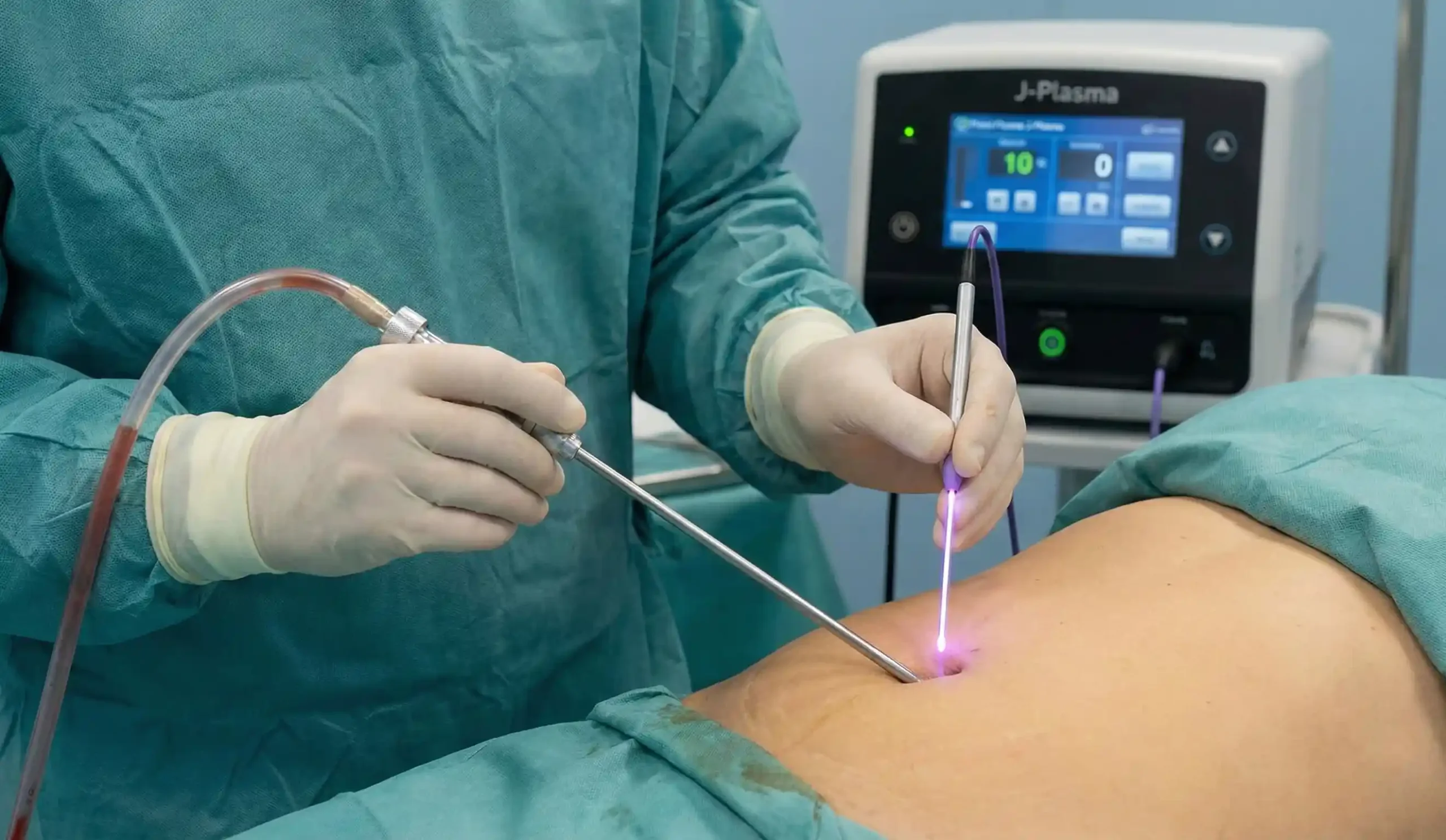 surgical procedure using j plasma handpiece and liposuction cannula