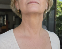 ten years necklift procedure