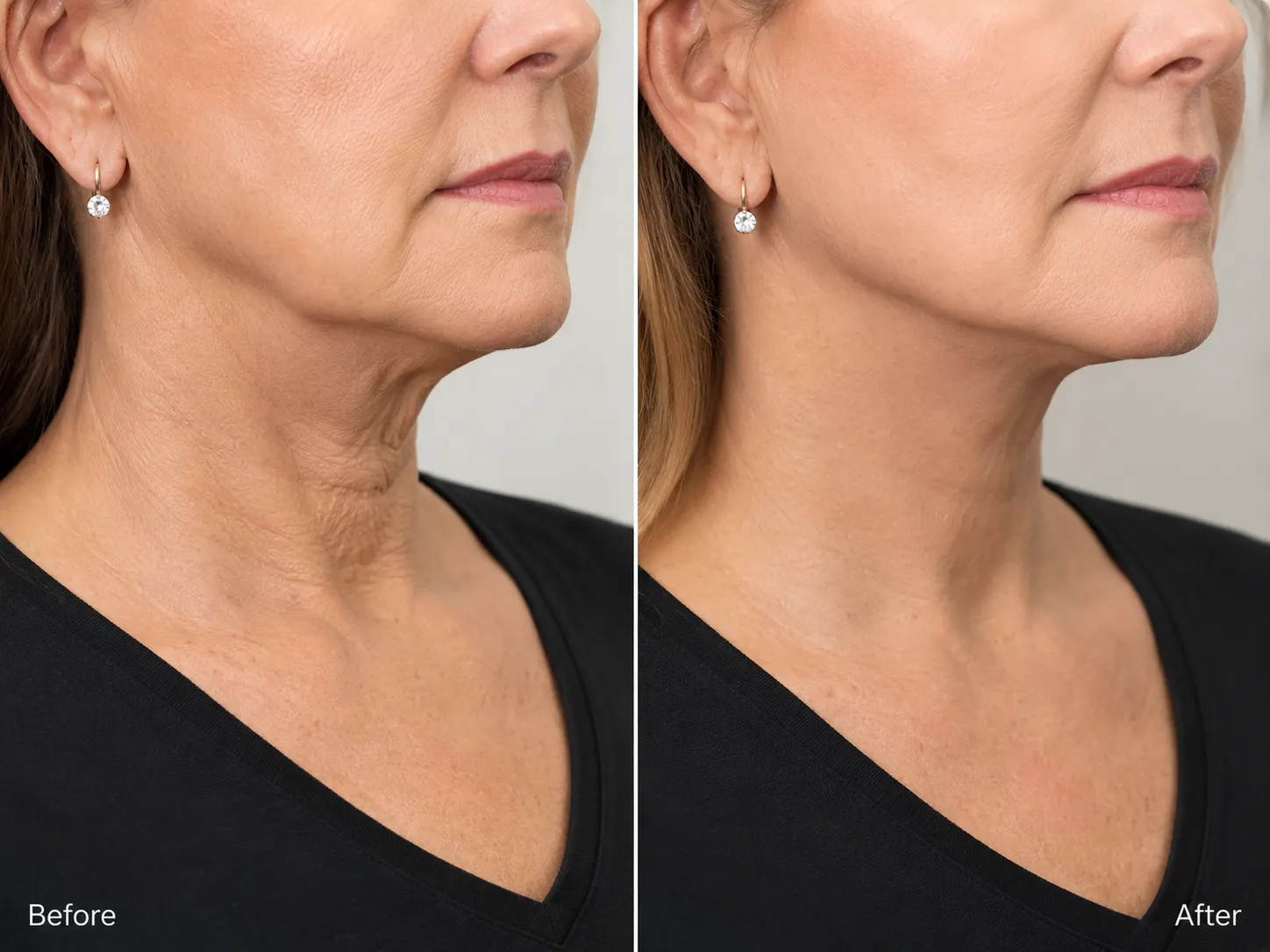 neck lift surgery