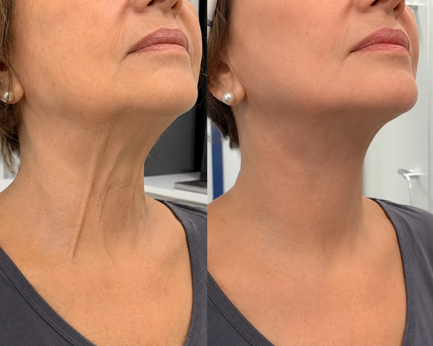 necklift after ten years before after