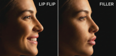 lip flip vs filler side profile comparison