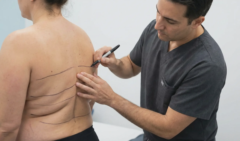 plastic surgeon marking back rolls for liposuction consultation