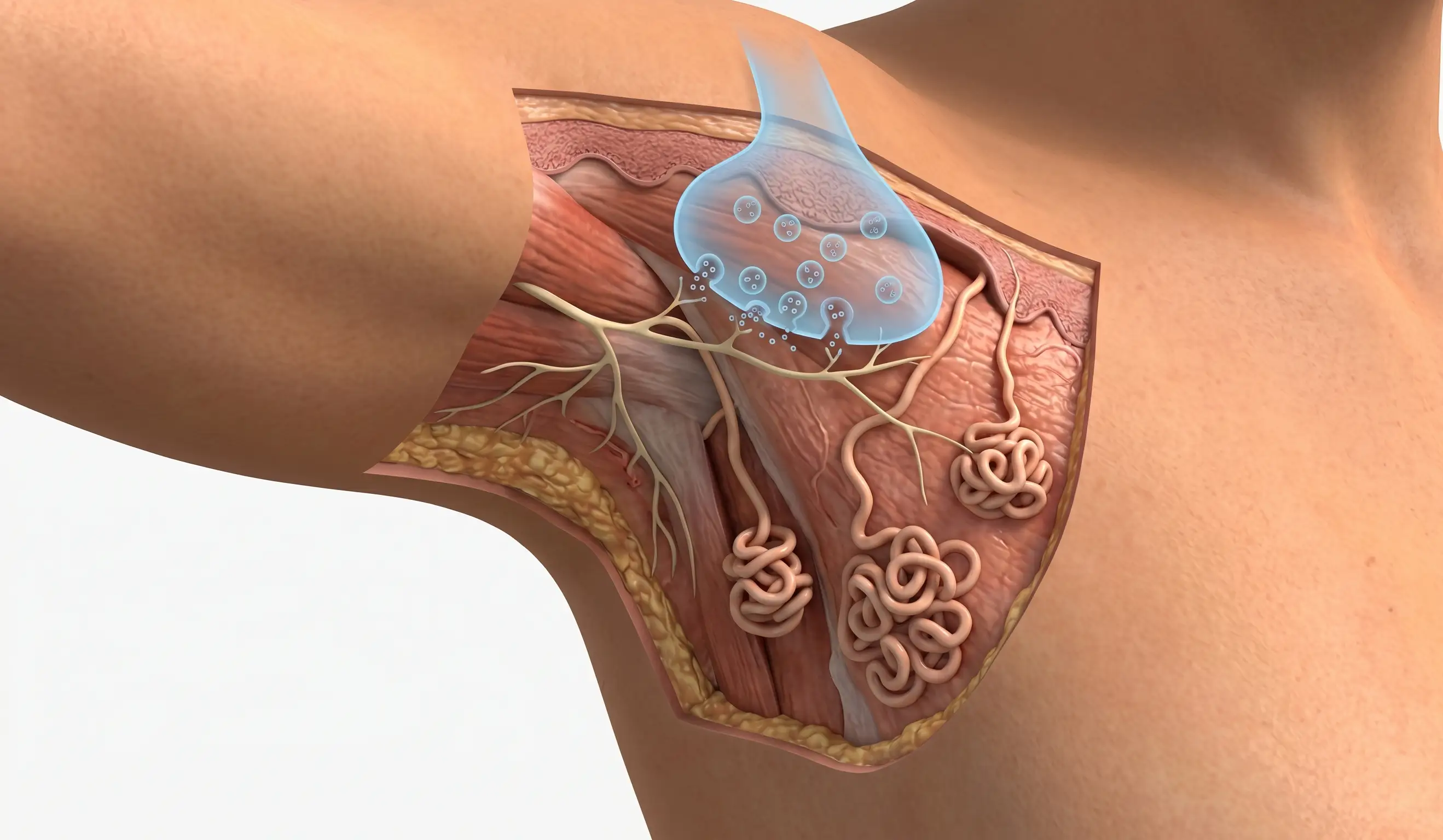 underarm botox