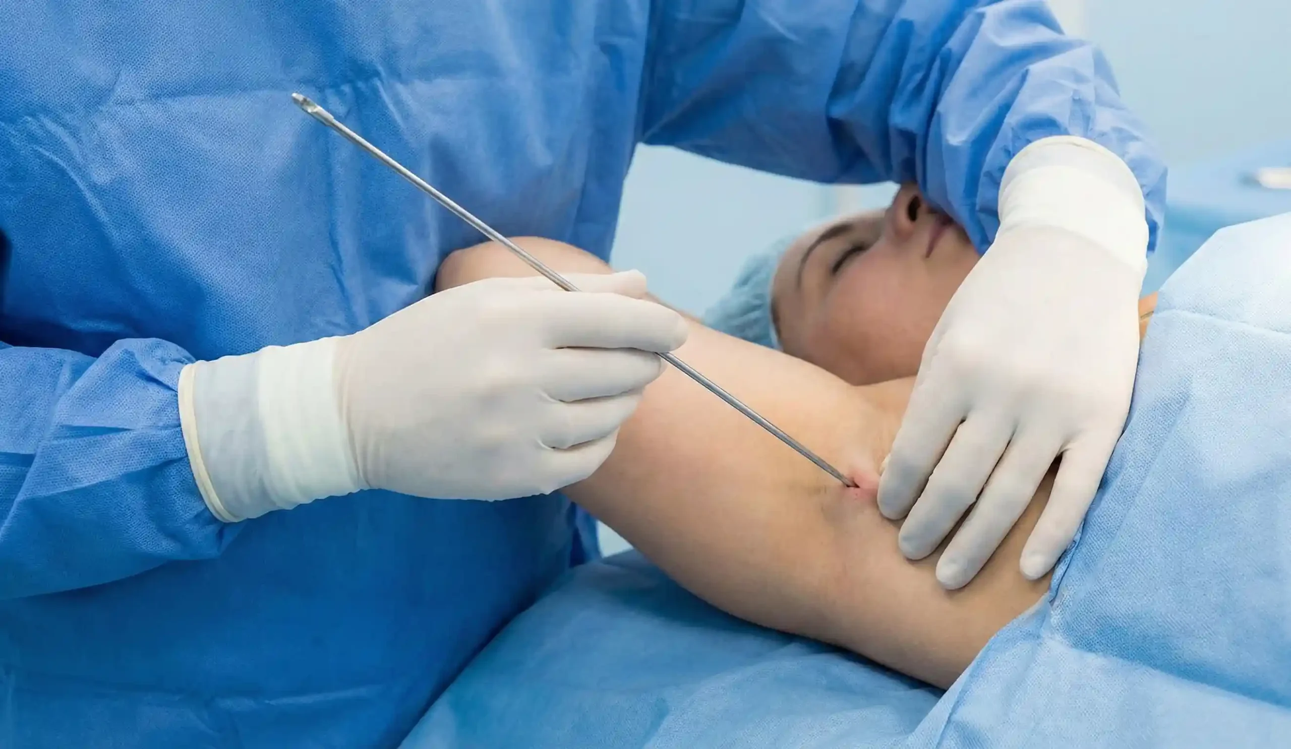 plastic surgeon performing minimally invasive breast liposuction with microcannula