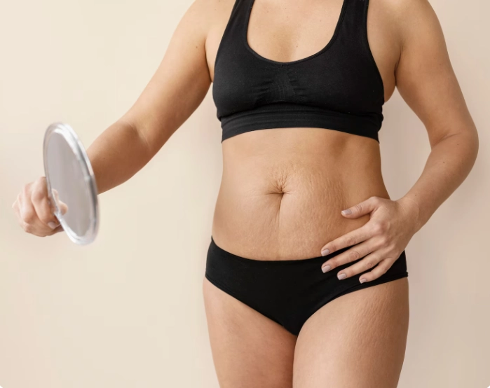 scarring from lipo