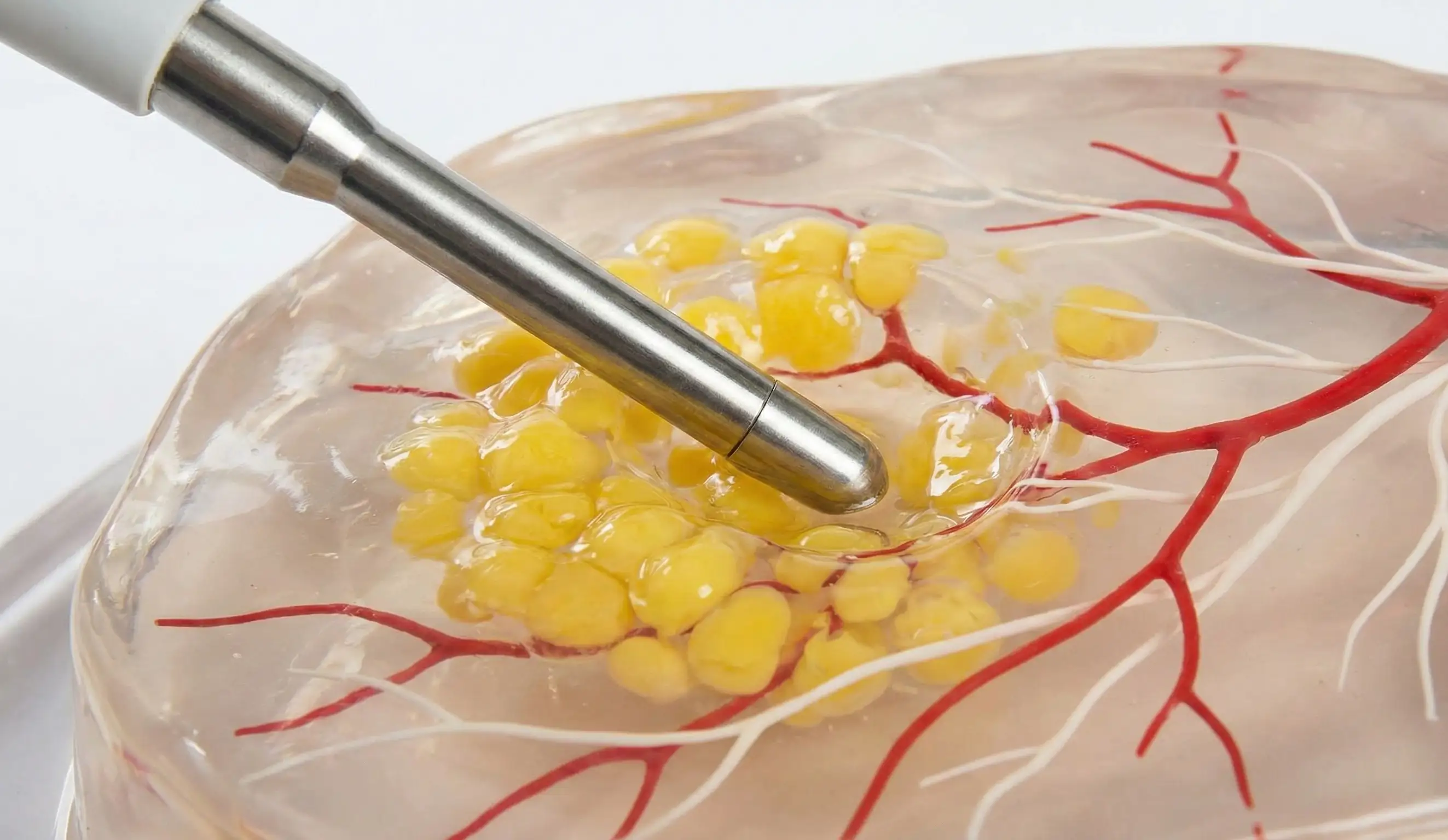 close up medical model showing ual probe liquefying fat cells