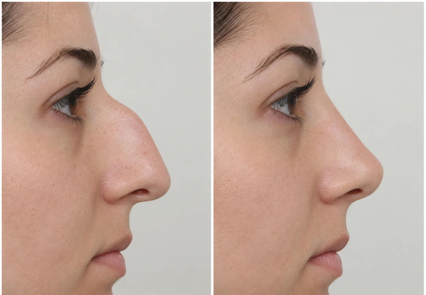 rhinoplasty before and after nose
