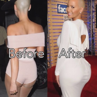 Amber Rose's BBL Surgery: Before and After