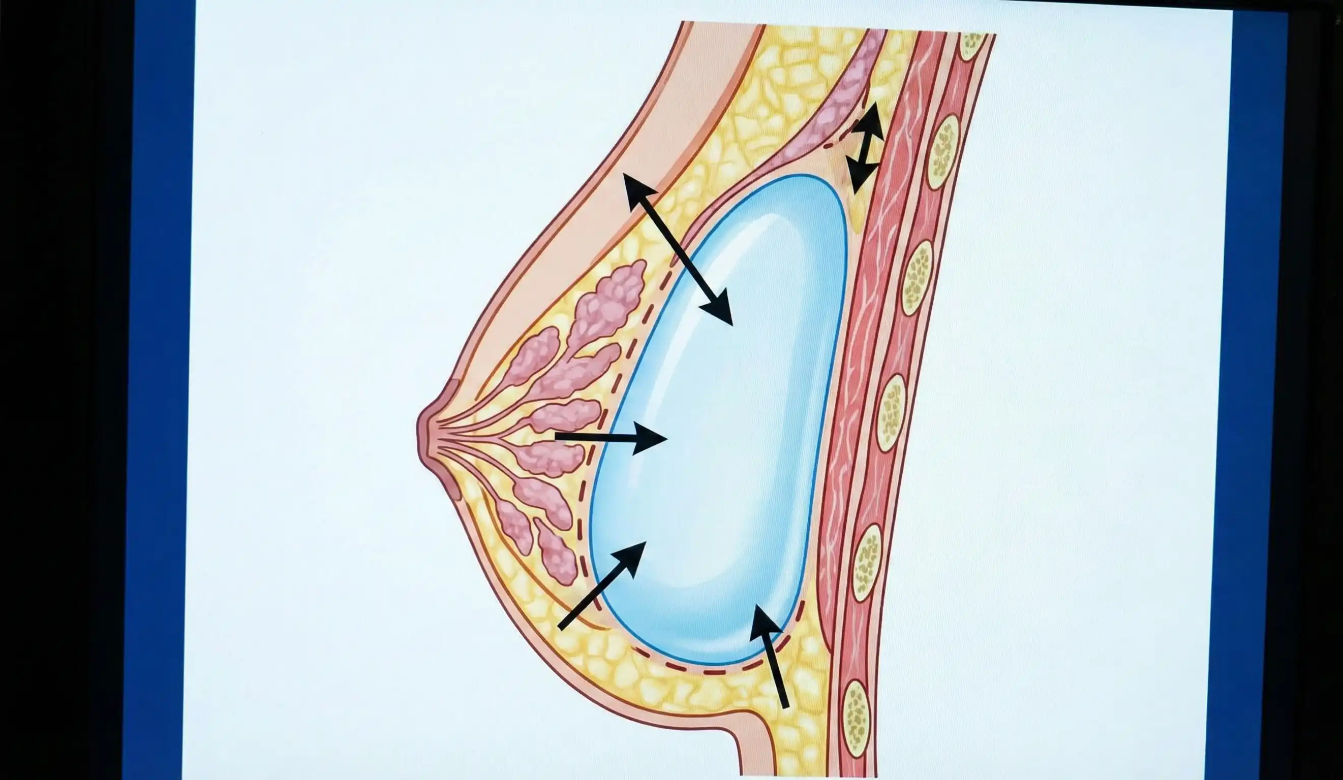 diagramă anatomică plasare implant mamar