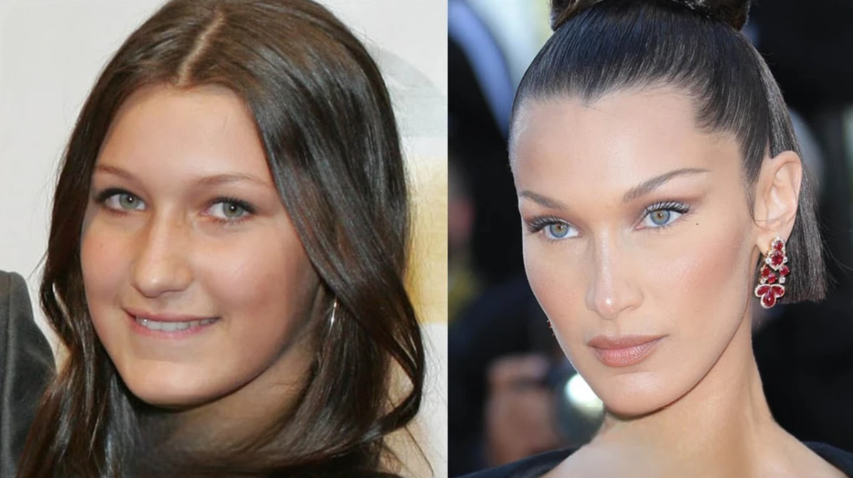 bella hadid rhinoplasty