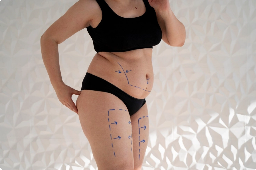 liposuciton in turkey