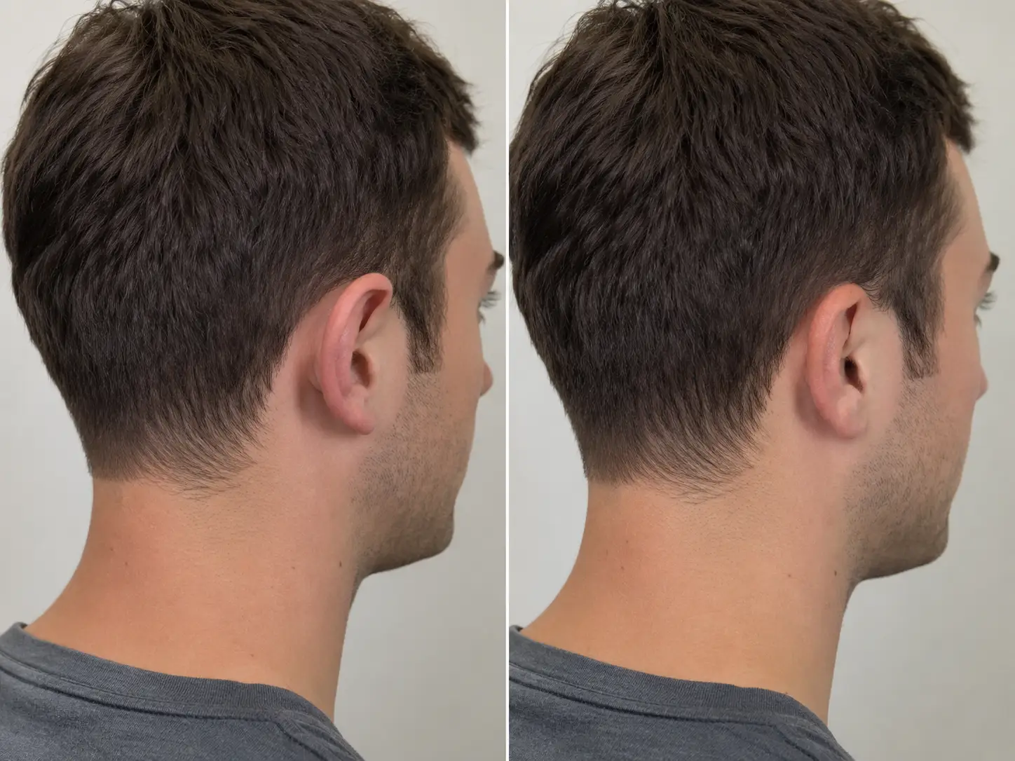 otoplasty before and after