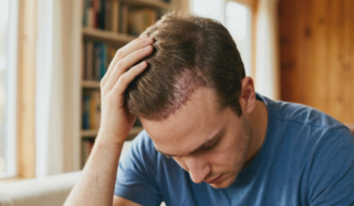 man examining scalp after hair transplant