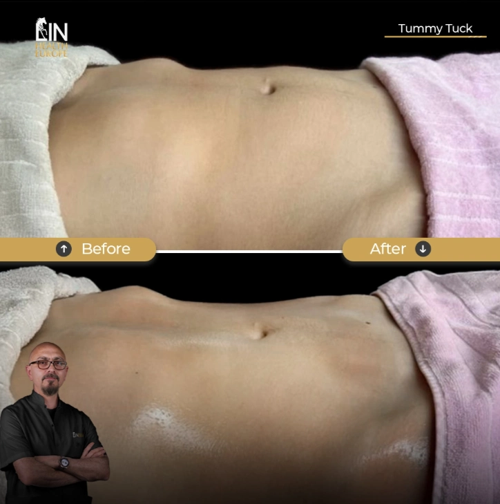 Liposuction Belly Before and After: What to Expect
