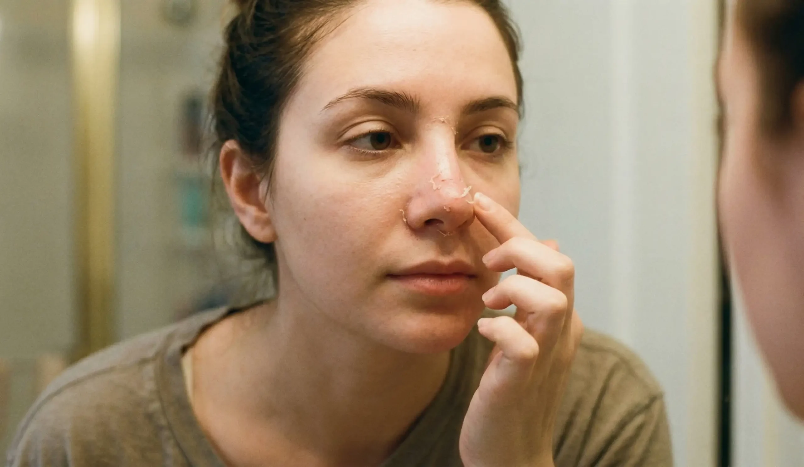rhinoplasty dead skin