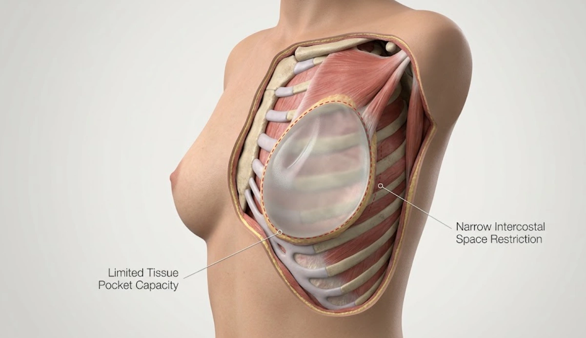 anatomical render petite frame 600cc implant safety