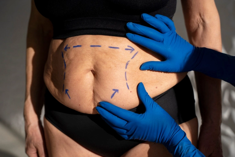 Liposuction in Istanbul, Turkey