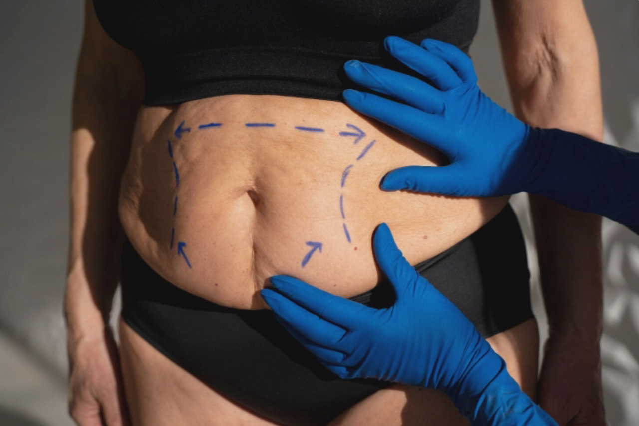 Liposcultura a Istanbul, Turchia