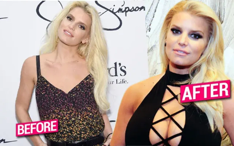 Jessica Simpson prima e dopo gli impianti mammari