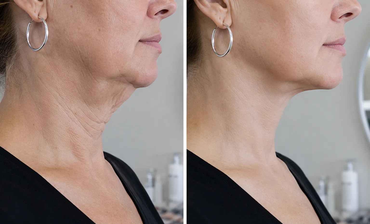 neck lift before and after photos of a patient