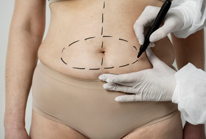 360 Liposuction: Full Body Contouring Explained